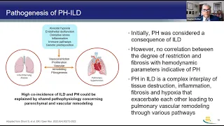 A Deeper Dive into the Early Recognition, Diagnosis, and Treatment of PH Associated with ILD