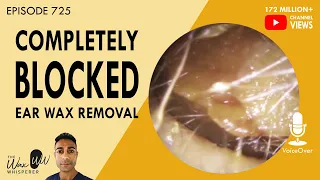 725 - Completely Blocked Ear Wax Removal