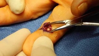 Live Surgery: Foreign Body (BB) Removal from Finger