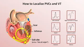 Advanced EKGs - Ventricular Tachycardia (Classification & Localization)