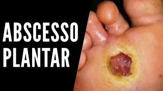 Abscesso plantar | Medicina Geral