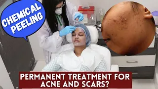 I got STRONG Chemical Peeling at the Clinic for ACNE | Is it a Permanent cure?#SkinTalkWSarah EP 20