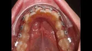 Crooked teeth braces lower jaw time lapse
