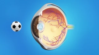 YAG Capsulotomy After Cataract Surgery
