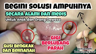 Obat Sakit Gigi Berlubang Paling Ampuh