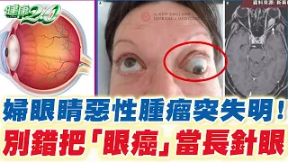 婦眼長「惡性腫瘤」突失明 微創切除不用摘眼球！ 眼癌 惡性機率高 健康2.0 精華 @tvbshealth20