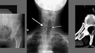 How to Interpret Lumbar X-Ray Images | How to Read Spine X-rays | How to Read Spine Imaging