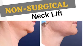 Non-Surgical Neck Lift | Permanent Results of Skin Secrets by Dr. McLaren