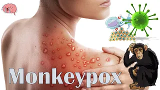 Monkeypox |The Latest Outbreak :- Everything You Need To Know - History, Prognosis, Treatment