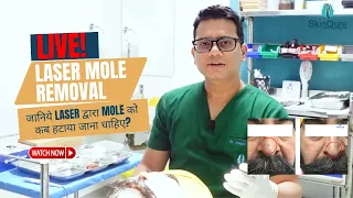 Live Mole Removal by Laser  |  Best Mole removal in Delhi | SkinQure | Dr Jangid