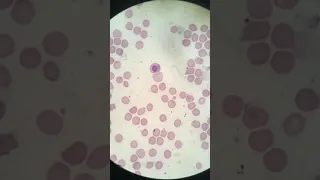 Leitura de uma anemia hemolítica