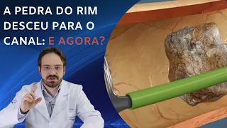 Pedra no Rim ou No Canal: Qual a Diferença?