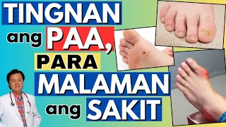 Tingnan ang Paa Para Malaman ang akit. - By Doc Willie Ong (Internist and Cardiologist)