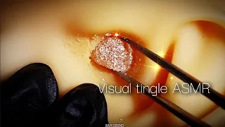 ASMR Remove earwax that is crispy on the outside and soft on the inside!! Visual Tingle Ear Cleaning