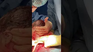 Childbirth with cesarean , c-section a new human enter the world full Vedic