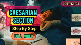 Caesarian Section- Step By Step | #obstetricsandgynecology #surgeryday|HHT#ep23|#health#edutainment