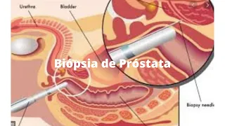 Biópsia de próstata