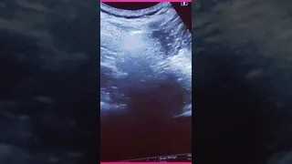 cyst drainage under ultrasound