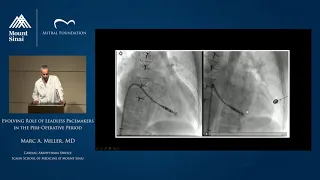 Evolving Role of Leadless Pacemakers in the Peri-operative Period