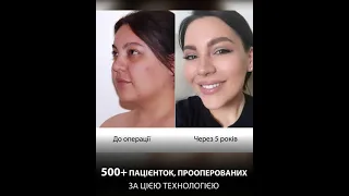 FaceTite в Офтальміці, Харків | Радиочастотная липосакция лица в Офтальмике. Хирург Аршакян В.А.