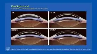 Quality of Life Before and After Keratoplasty for Fuchs Endothelial Dystrophy