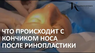 ЧТО ПРОИСХОДИТ С КОНЧИКОМ НОСА ПОСЛЕ РИНОПЛАСТИКИ