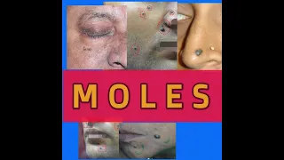 #Facial mole removal before and after#MOLE REMOVAL#  BY RADIO FREQUENCY