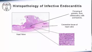 Endocarditis: Pathophysiology