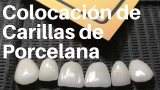 COLOCACIÓN de CARILLAS de Porcelana👅#carillasdentales