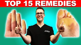 Raynaud's Syndrome Top 15 Remedies [Symptoms & Best Treatment]