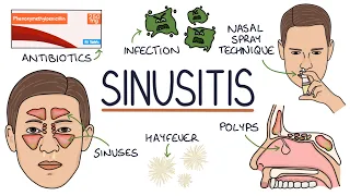 Understanding Sinusitis