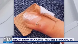 Woman Warns Others How Manicure May Have Given Her Cancer