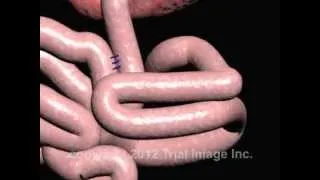 Intussusception of the Bowel video - Animation by Cal Shipley, M.D.