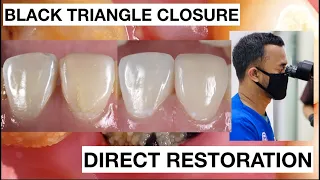 Black Triangle Closure Direct Bonding Composite Restoration | General Dentist Griya RR