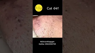 Cut 641 Acne of a men ep2 #acne #whiteheads