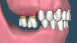 Perda dental e suas consequências - vídeo 4