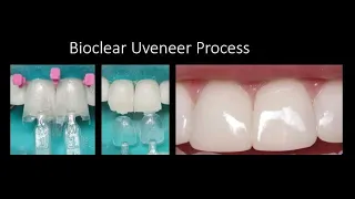 Direct Composite Veneers using the Bioclear Uveneer Process