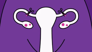 Brook Contraception - Sterilisation Animation