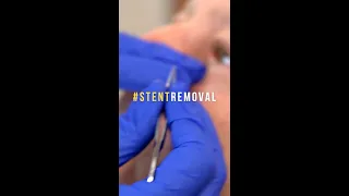 Stent Removal After Lacrimal Tear Duct Surgery