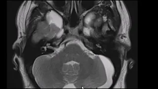 Mega cisterna magna, arachnoid cyst, and Dandy Walker variant | First Look MRI