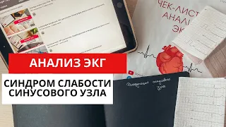 Синдром слабости синусового узла (СССУ-дисфункции синусового узла). ЭКГ. Причины. Симптомы.