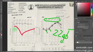 Cтепень тугоухости: как определить падение слуха по аудиограмме (аудиометрия)