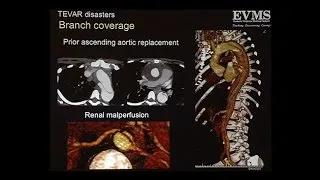 Proximal Aortic Dissection and Other Disasters After TEVAR Deployment