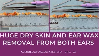 HUGE DRY SKIN AND EAR WAX REMOVAL FROM BOTH EARS - EP173