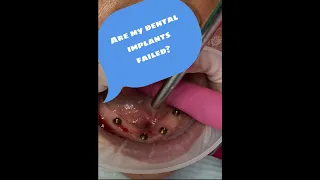 Are my All on 4 dental implants failed?