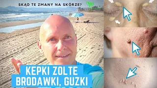 Skąd te różne cuda na naszej skórze 🤔😳⁉️ Martwić się 🤔⁉️ Co zrobić 🙏🤔⁉️