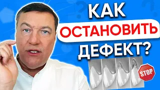 Клиновидный ДЕФЕКТ зубов лечение. Как остановить? Ставить ли пломбу?