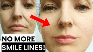 HOW TO GET RID OF SMILE LINES, NASOLABIAL FOLDS, MARIONETTE LINES, SMOKER LINES