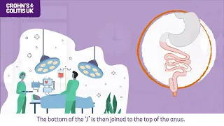 Types of surgery for Colitis