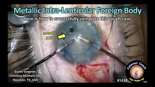 CataractCoach 1438: metallic intra-lenticular foreign body